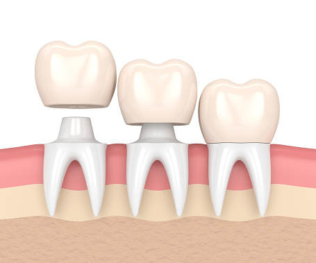  3D rendering showing the placement of a dental crown on a tooth abutment