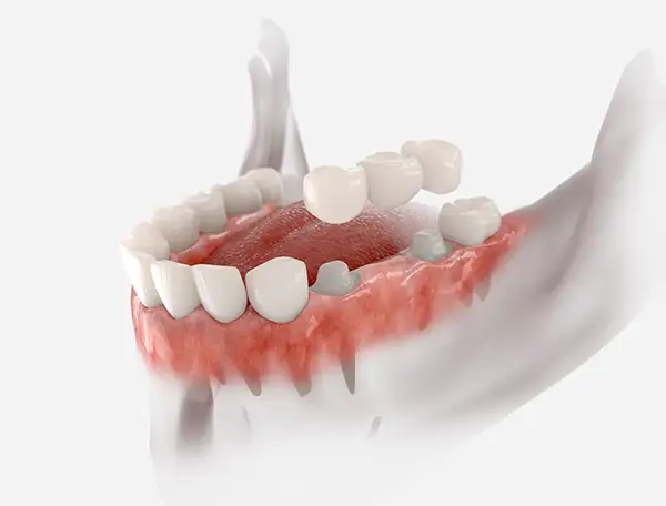 dental bridge 3