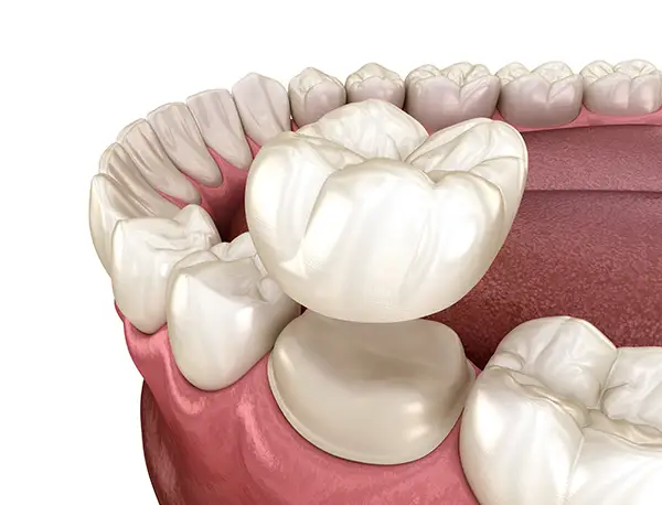 dental crown 2