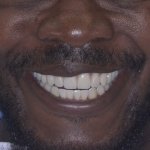 Man smiling after full mouth restoration