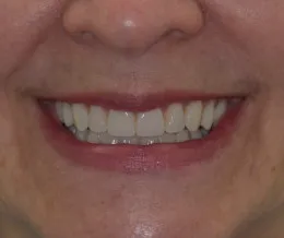 Woman smiling with straight, even teeth