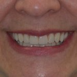 Woman smiling with straight, even teeth