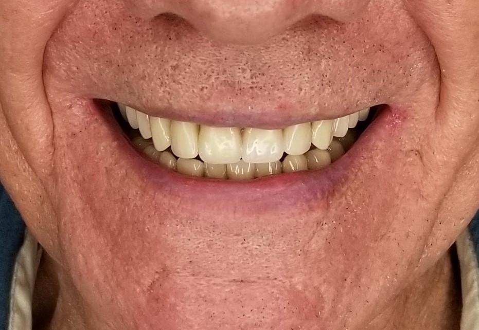 Restored smile after a custom denture.