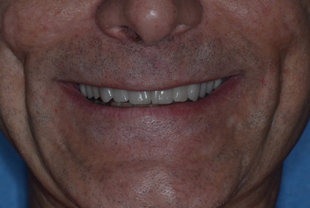 Straight smile after full mouth restoration