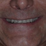 Straight smile after full mouth restoration