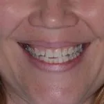 Woman smiling with crooked teeth