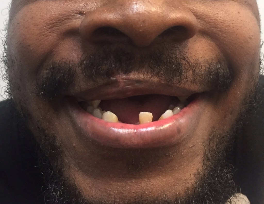 Man with several missing teeth