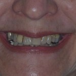 Woman with crooked teeth