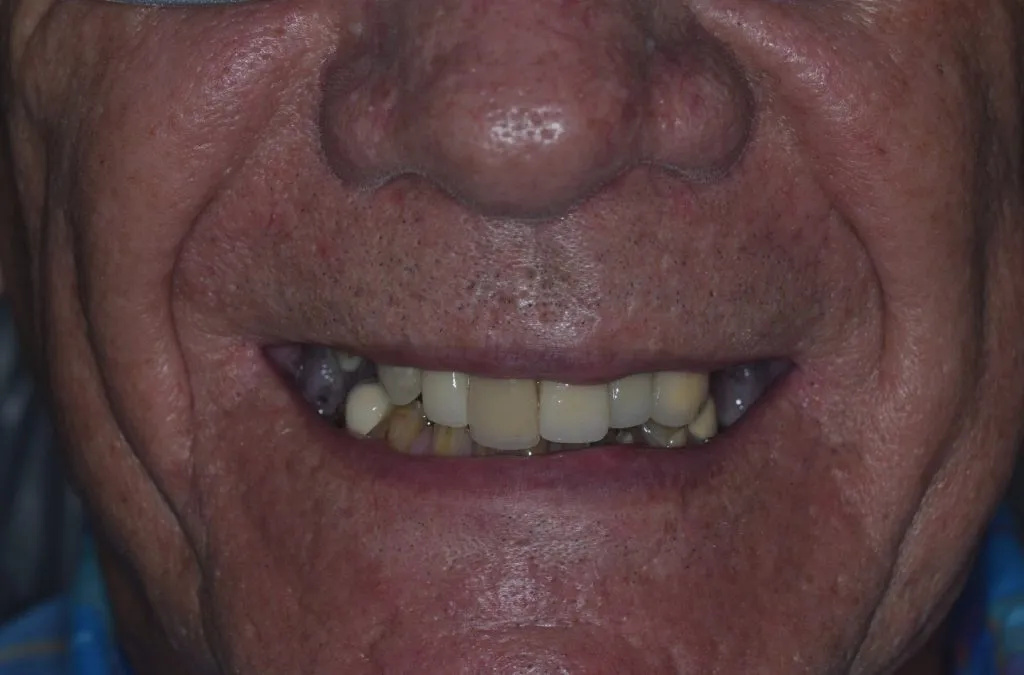 Crooked uneven teeth.