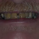 Man with uneven and crooked teeth