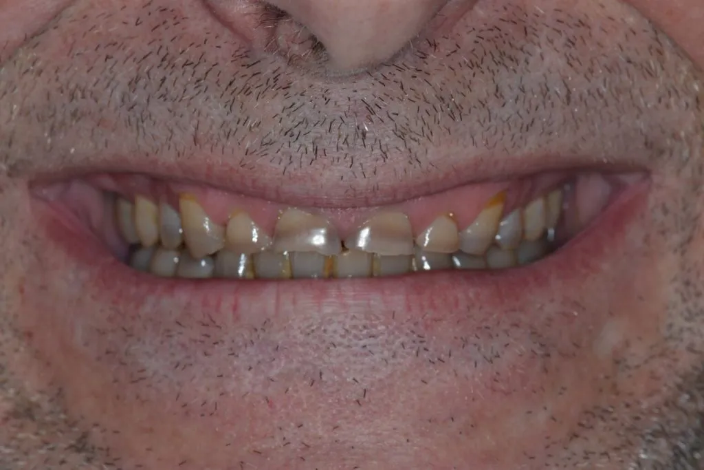 Small uneven teeth before full mouth restoration