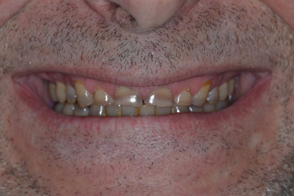 Small uneven teeth before full mouth restoration
