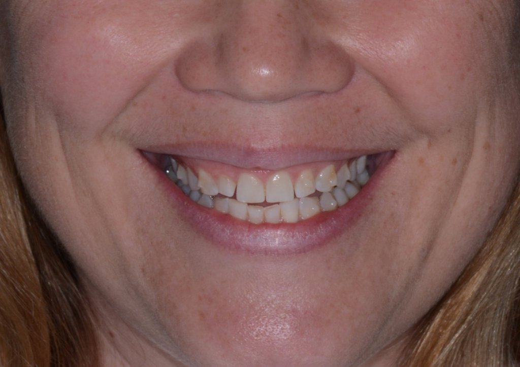 Woman smiling with crooked teeth