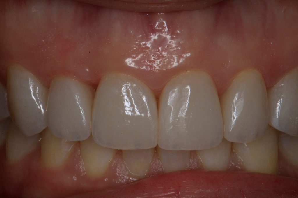 Close up view of front teeth after cosmetic treatment 