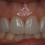 Close up view of front teeth after cosmetic treatment 