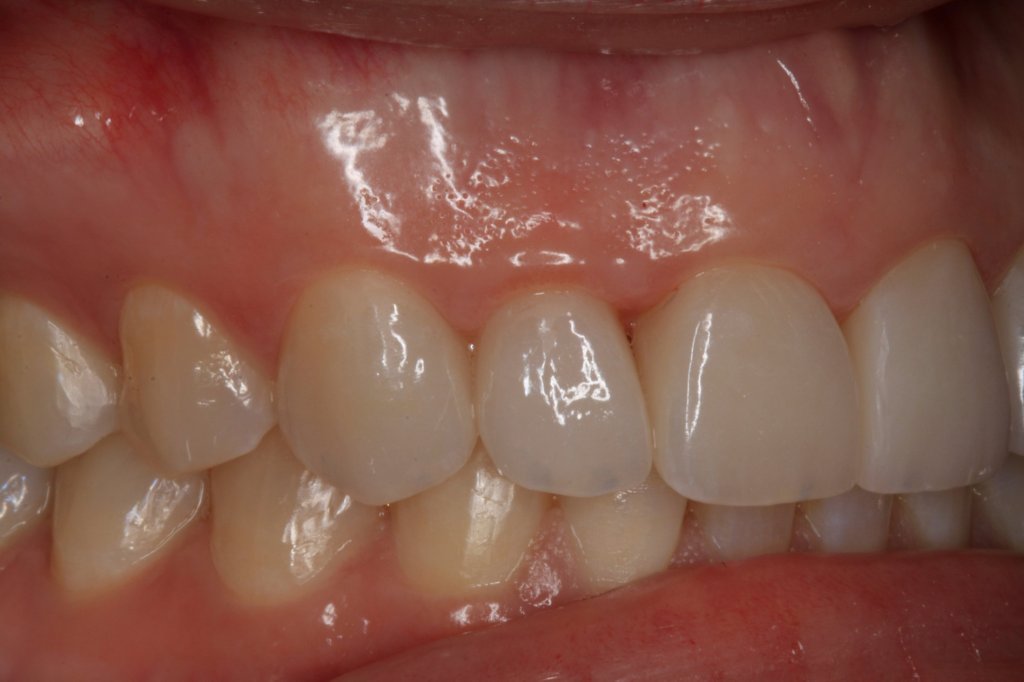 Close up view of uneven teeth