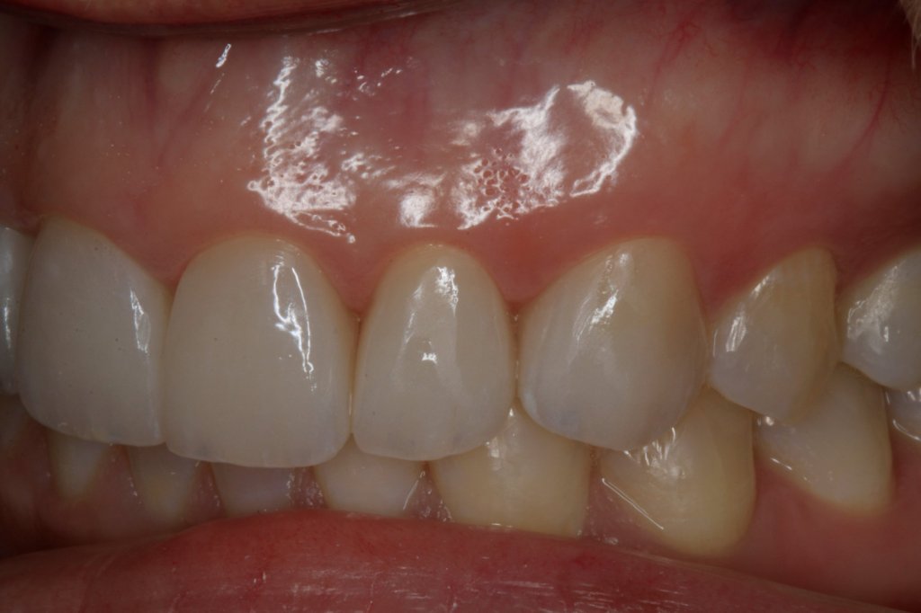 Close up view of teeth after cosmetic treatment