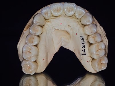 Underneath view of the top teeth from the lab